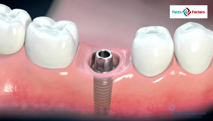 Global Dental Implants Market